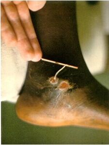 Guinea worm obtained from the leg of a person suffering from dracunculiasis